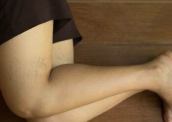 Varicose Veins In The Legs