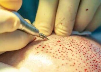 Effective Hair Restoration Treatment