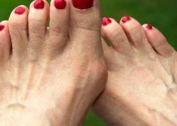 Least Known Facts About Bunions