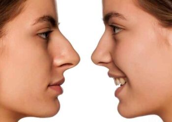 Rhinoplasty