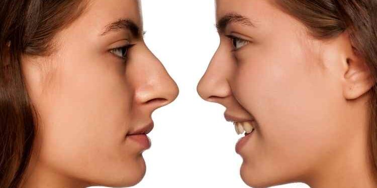 Rhinoplasty