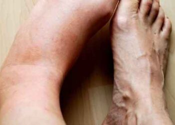 Reasons You Could Be Experiencing Swollen legs