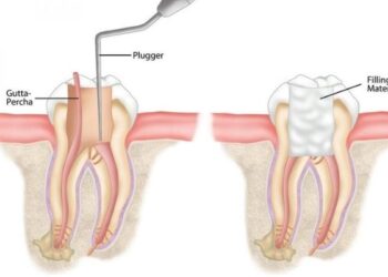 Root Canal Vs Extraction