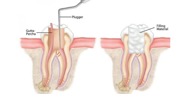 Root Canal Vs Extraction