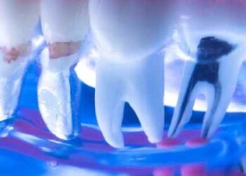 Preserve Your Damaged or Infected Teeth with Root Canal Treatment