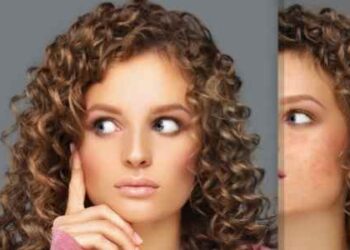 Types of Acne Scars and Their Treatment