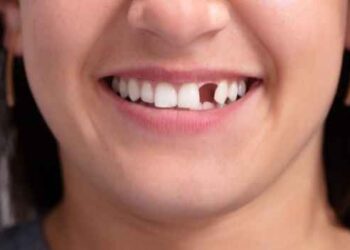 Replace Your Missing Tooth or Teeth Through Dental Implants