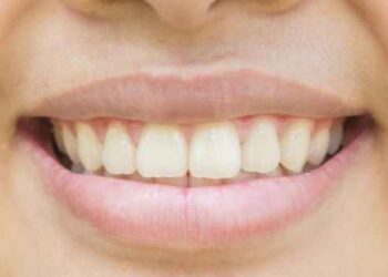 What You Can Do About Those Yellow Teeth