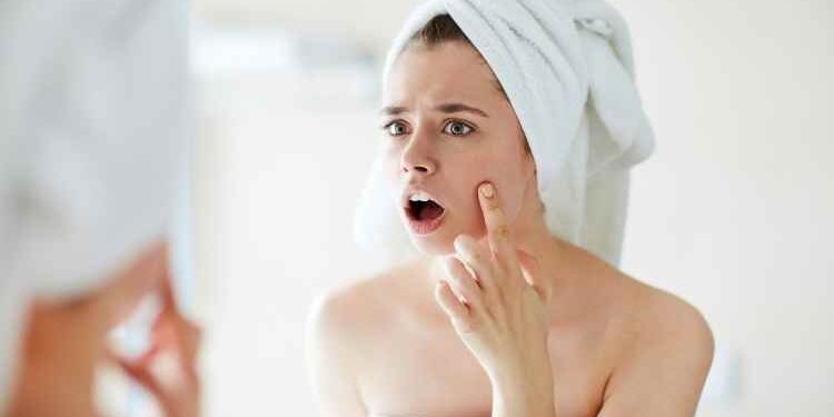 Everything You Need to Know About Acne