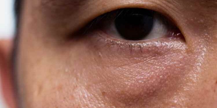 All You Need to Know About Droopy Eyelids