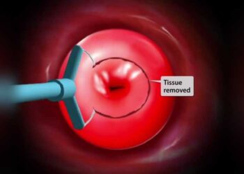 Important Facts to Know About LEEP