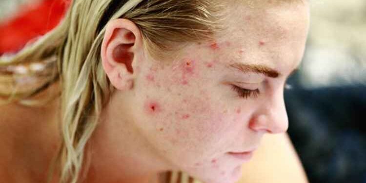Top 7 Benefits of Using a Salicylic Acid Face Wash