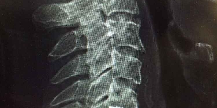 Artificial Disc Replacement Surgery