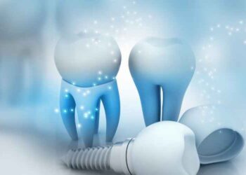 Getting Dental Implants in Glendale