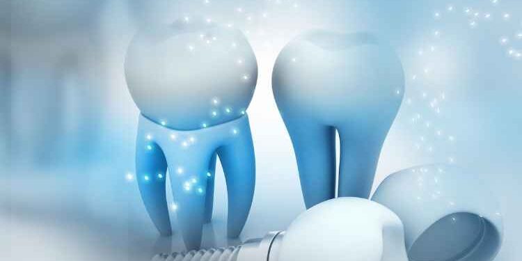 Getting Dental Implants in Glendale
