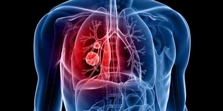 7 Steps You Can Take to Lower Your Risk of Lung Cancer