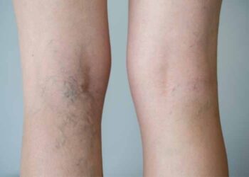 Are Varicose Veins Treatable