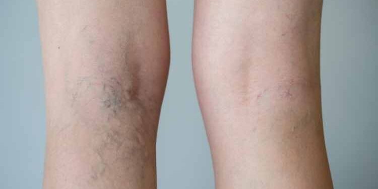 Are Varicose Veins Treatable