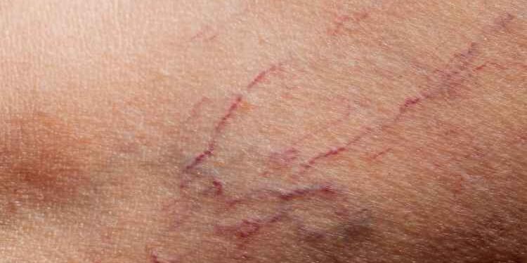 Benefits Of Spider Vein Treatment