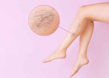 Six Effective Ways to Manage Your Varicose Veins