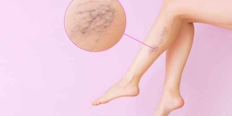 Six Effective Ways to Manage Your Varicose Veins