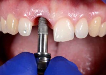 The Full Dental Implant Procedure in Less Than 500 Words