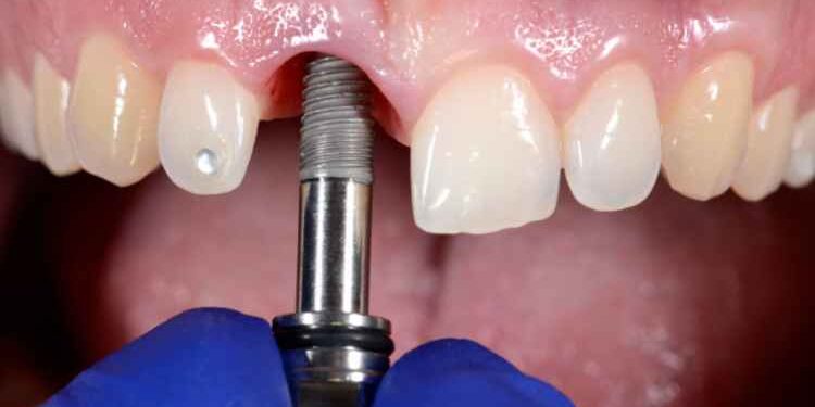 The Full Dental Implant Procedure in Less Than 500 Words