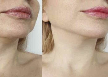 Explore the Latest HIFU Treatment Innovations