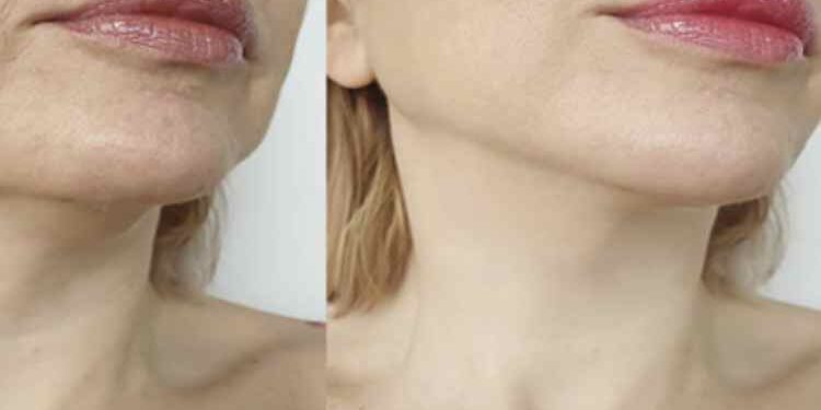Explore the Latest HIFU Treatment Innovations