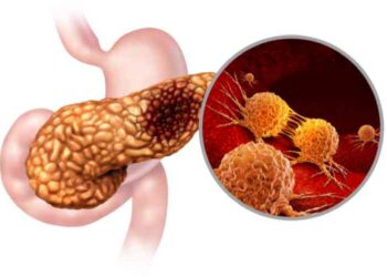 The Role of Diet and Lifestyle in Preventing Pancreatic Cancer