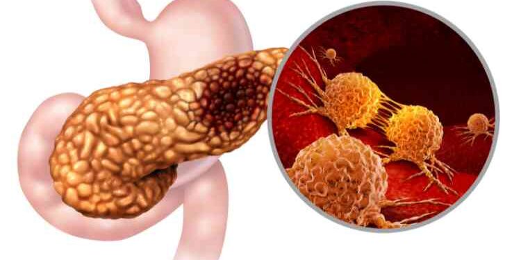 The Role of Diet and Lifestyle in Preventing Pancreatic Cancer