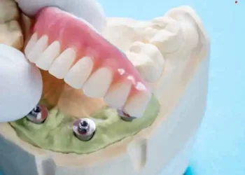 The Definitive Guide to All-on-4 Denture Implants